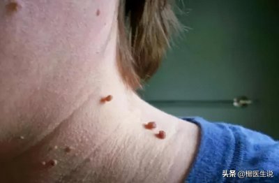 ​脖子上、耳朵上的“小肉瘤”是什么？如何处理？一文说清楚
