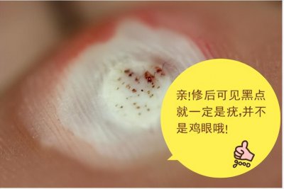​“鸡眼、瘊子、老茧”傻傻分不清？