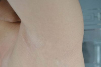 ​脖子上、腋下长出的“小肉粒”是什么？很多人对此分辨不清