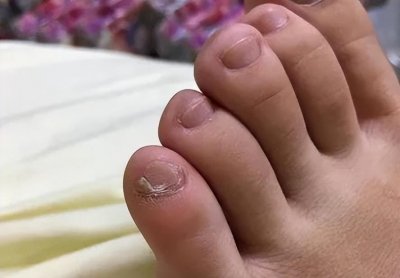 ​小脚趾指甲分成两瓣的人，到底是什么来历？你的指甲是这样吗？