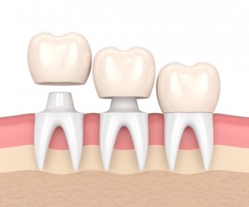 ​什么是临时牙？为什么要做临时牙？