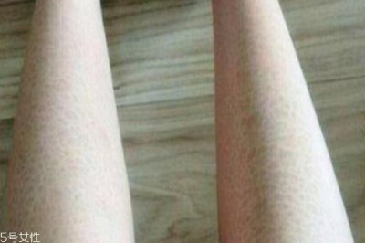 ​腿上皮肤干燥像鱼鳞 有可能是鱼鳞病