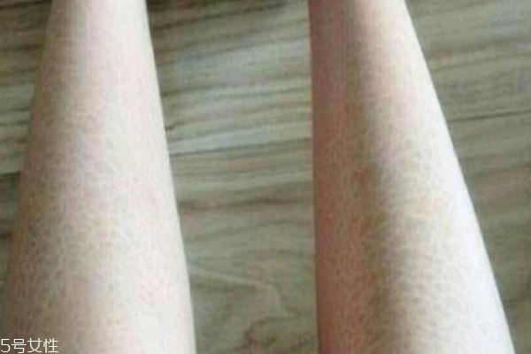 腿上皮肤干燥像鱼鳞 有可能是鱼鳞病