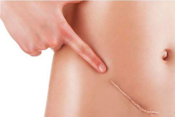 疤克是什么 一天要抹几次疤克 疤克是什么 一天要抹几次疤克