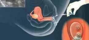 为什么明星容易生双胞胎？知道这些你还愿意做吗？